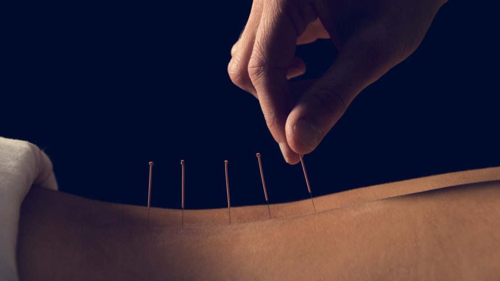Acupuncture » Bozeman Acupuncture