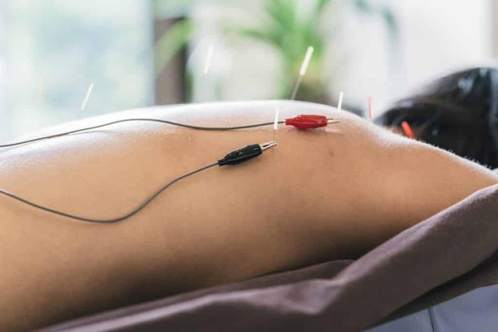 Electro Stimulation » Bozeman Acupuncture
